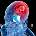 O Papel da Radioterapia no Tratamento do Câncer de Cérebro