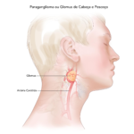 Tratamento do Glomus ou Paraganglioma de Cabeça e Pescoço