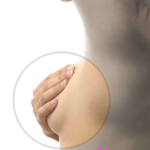 Efeitos Colaterais da Radioterapia de Mama