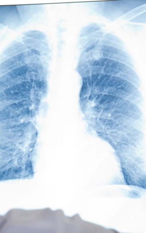 cancer-de-pulmao